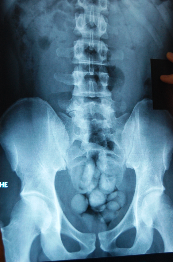 Image aux rayons X d'un passeur de drogue - body packer